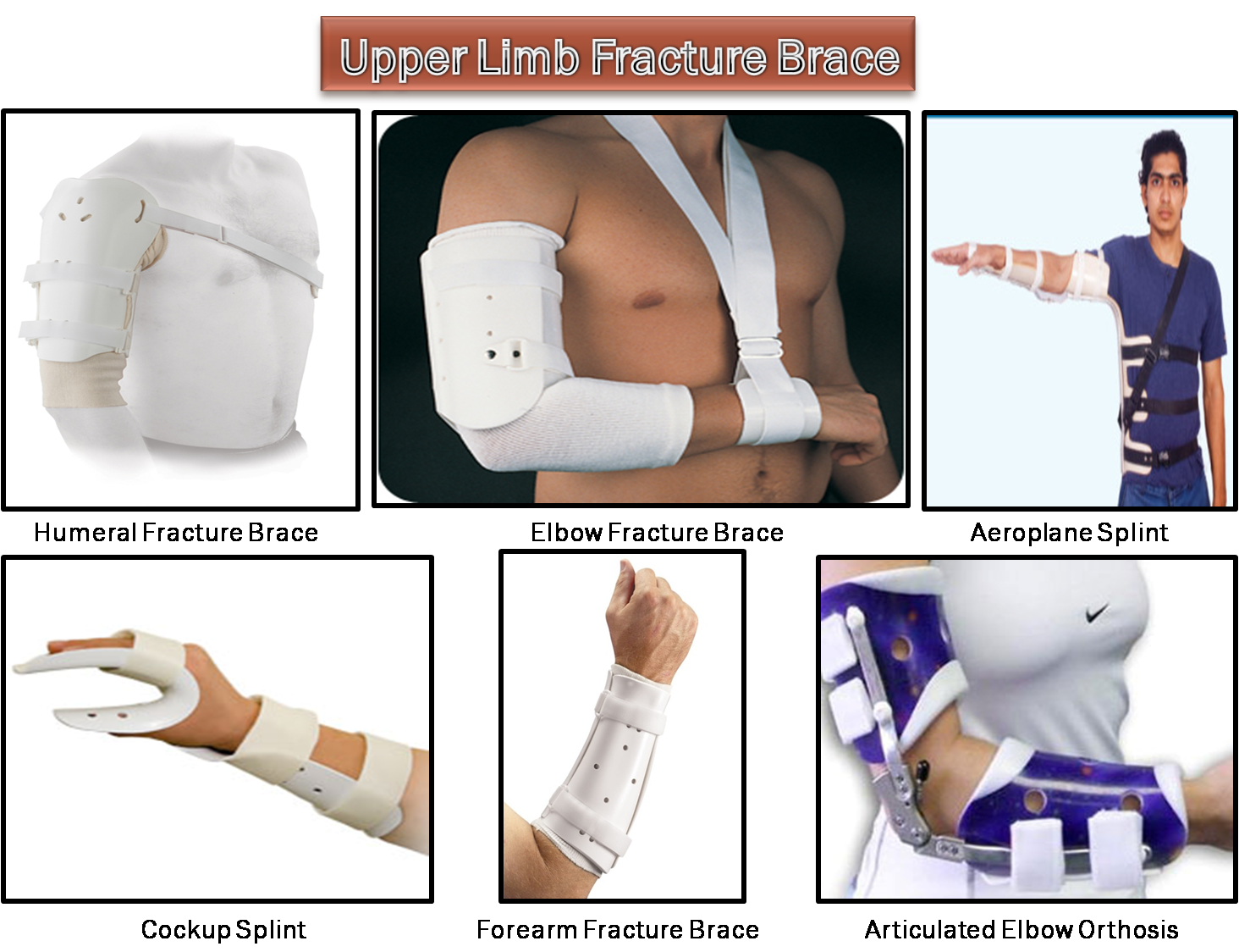 Upper Limb fracture brace Creative Orthotic and Prosthetic Solutions